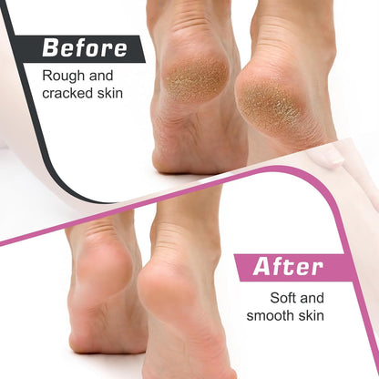 Professional Electric Callus Remover with Speed Control and 60 Replacement Sandpaper Disks - Ultimate Foot Care Tool for Smooth, Soft Feet