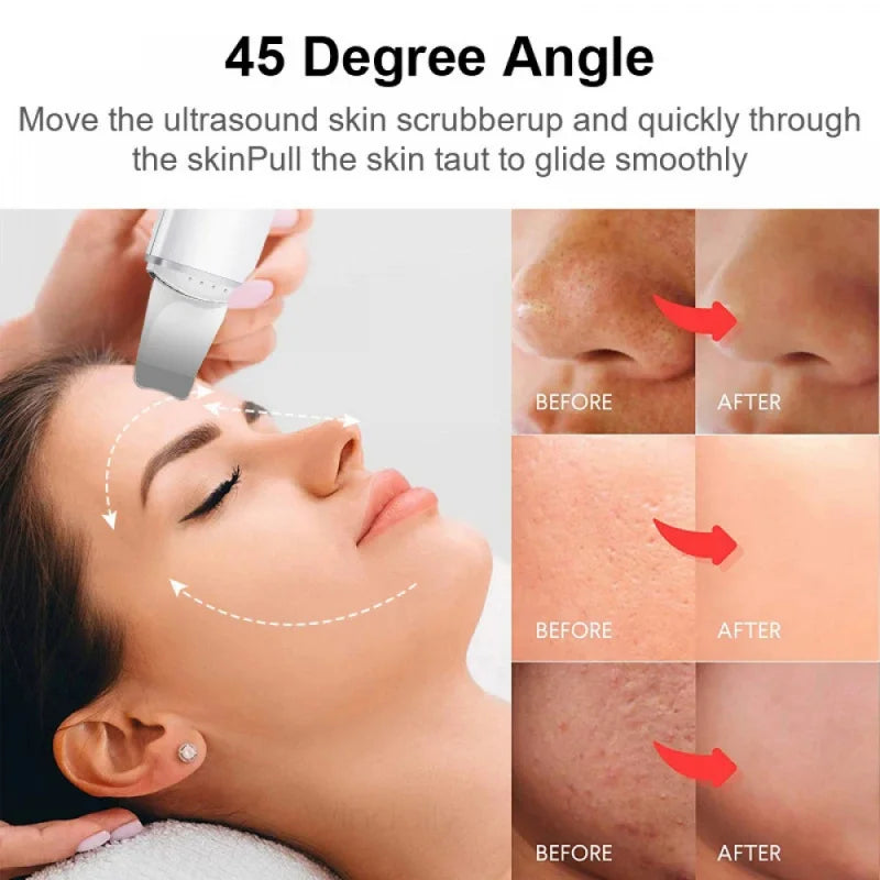 Revitalize Your Skin with the Ultrasonic Skin Care Spatula - Blackhead Remover & Facial Exfoliation Tool