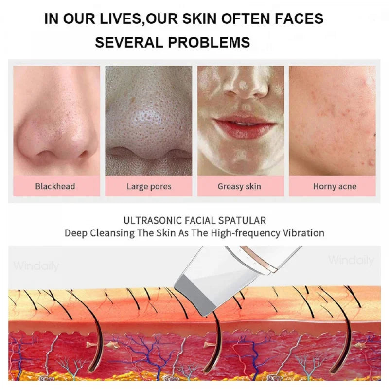 Revitalize Your Skin with the Ultrasonic Skin Care Spatula - Blackhead Remover & Facial Exfoliation Tool