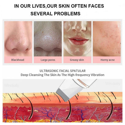 Revitalize Your Skin with the Ultrasonic Skin Care Spatula - Blackhead Remover & Facial Exfoliation Tool